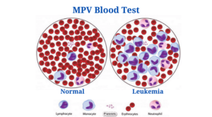 MPV Blood Test: Calculation, High and Low MPV Value, Results