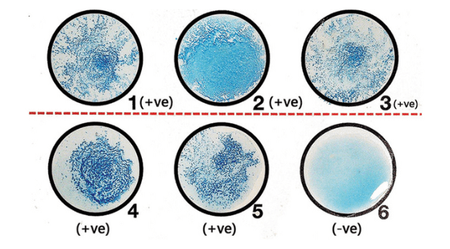 Results of Latex Agglutination Test