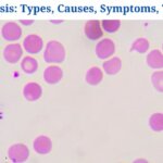 Anisocytosis: Definition, Types, Causes, Symptoms, Treatment
